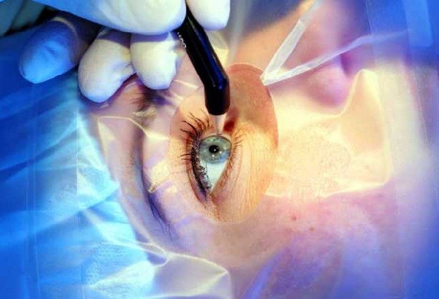 В Германии пациенту имплантировали линзу рекордной оптической силы — 40 диоптрий